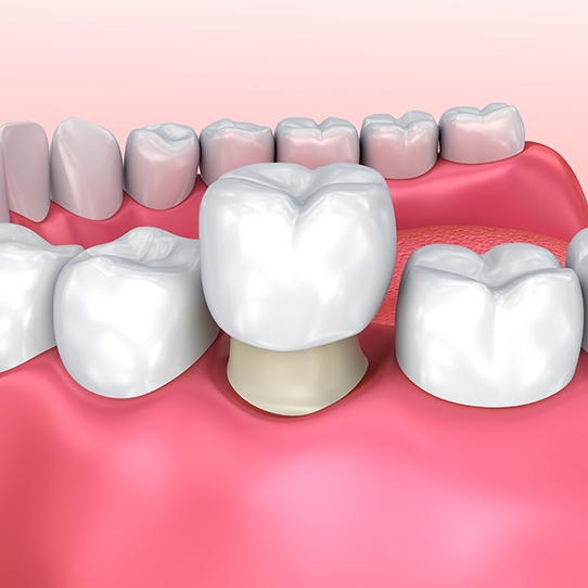 Animated dental crown restoration