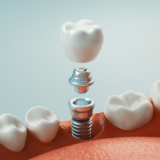 Animated part of the dental implant and replacement tooth