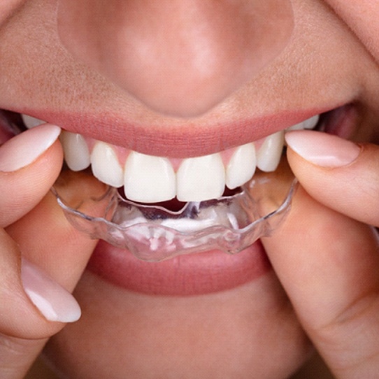 An up-close image of a woman inserting a clear aligner into the upper arch of teeth