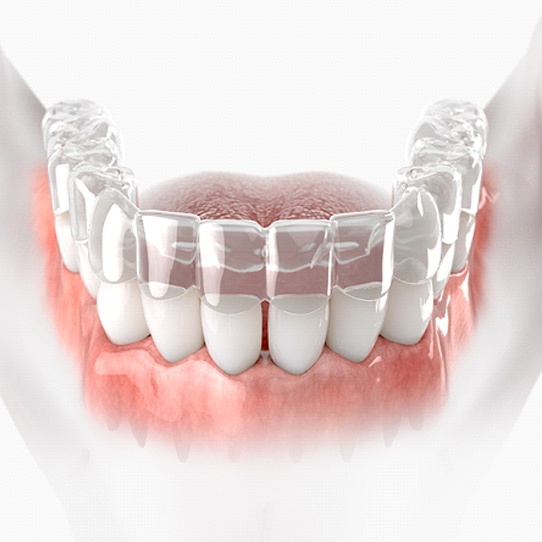 A digital image of a clear aligner being placed over the lower arch of a person’s teeth