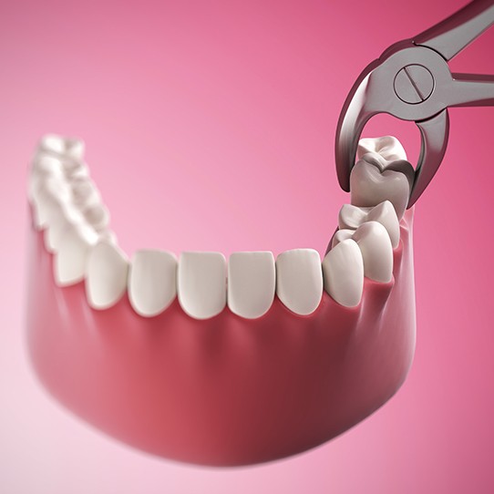Animated tooth extraction process